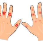 Artrite Idiopática Juvenil