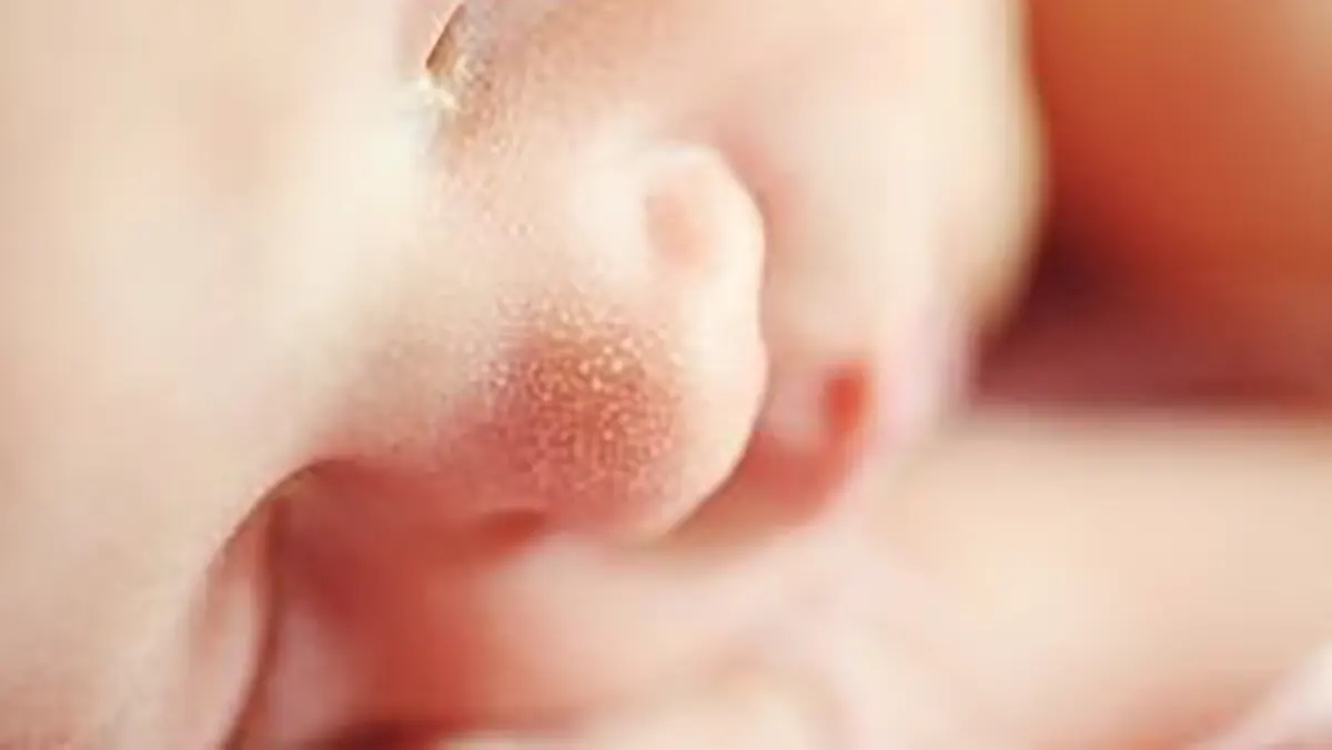 Icterícia neonatal